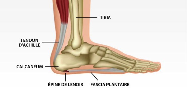 Souffrez-vous d’une fasciite plantaire, d’une épine de Lenoir ou d’une myoaponévrosite plantaire ?