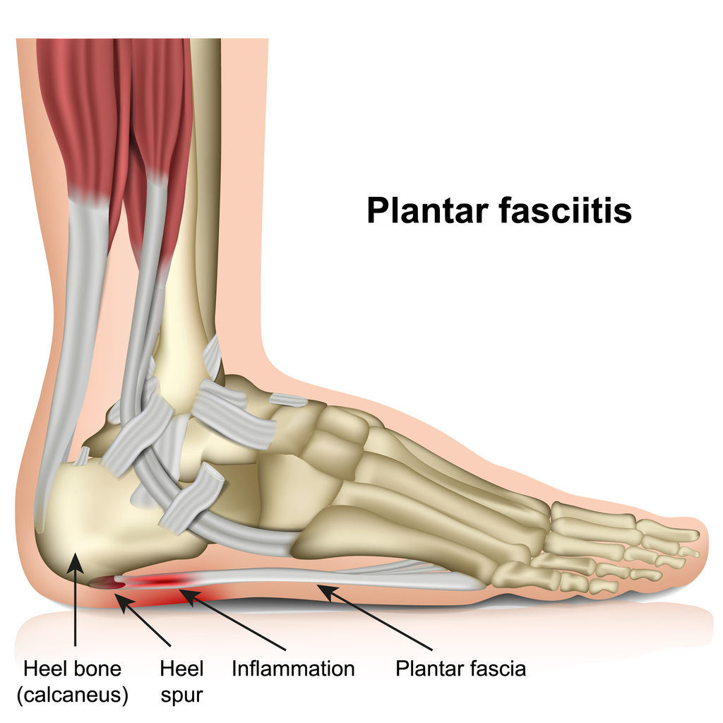 fasciite plantaire